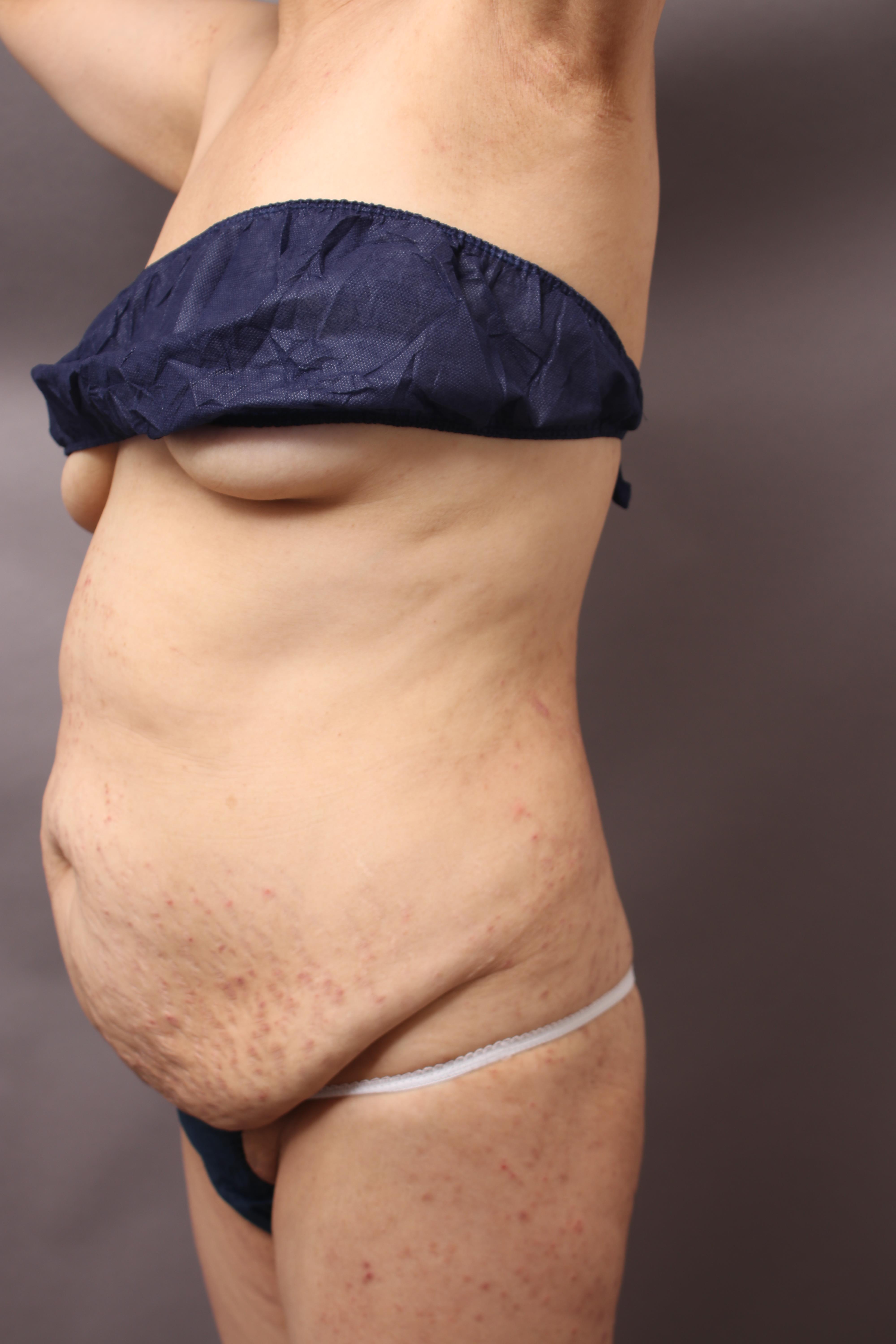 産後のたるんだお腹 タミータック手術で出産前の引き締まったラインに 大橋昌敬の脂肪吸引ブログ