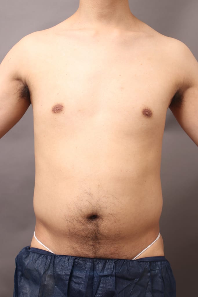 Vaser4d 30代でいつの間にかポッコリお腹 たった1週間でこの魅力的なボディライン 大橋昌敬の脂肪吸引ブログ